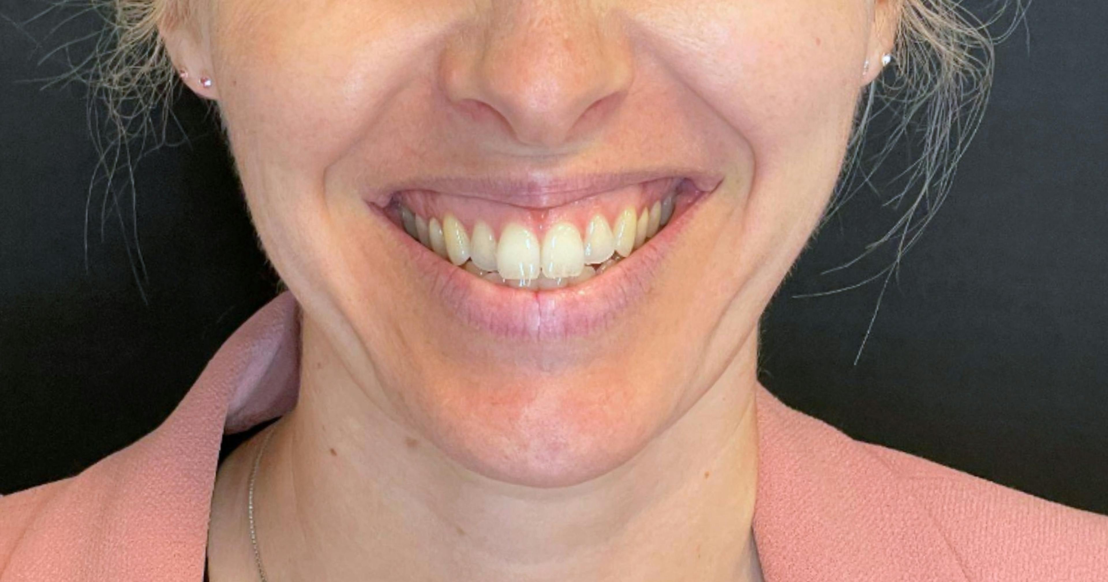 Treating a gummy smile with toxin - excessive gingival display