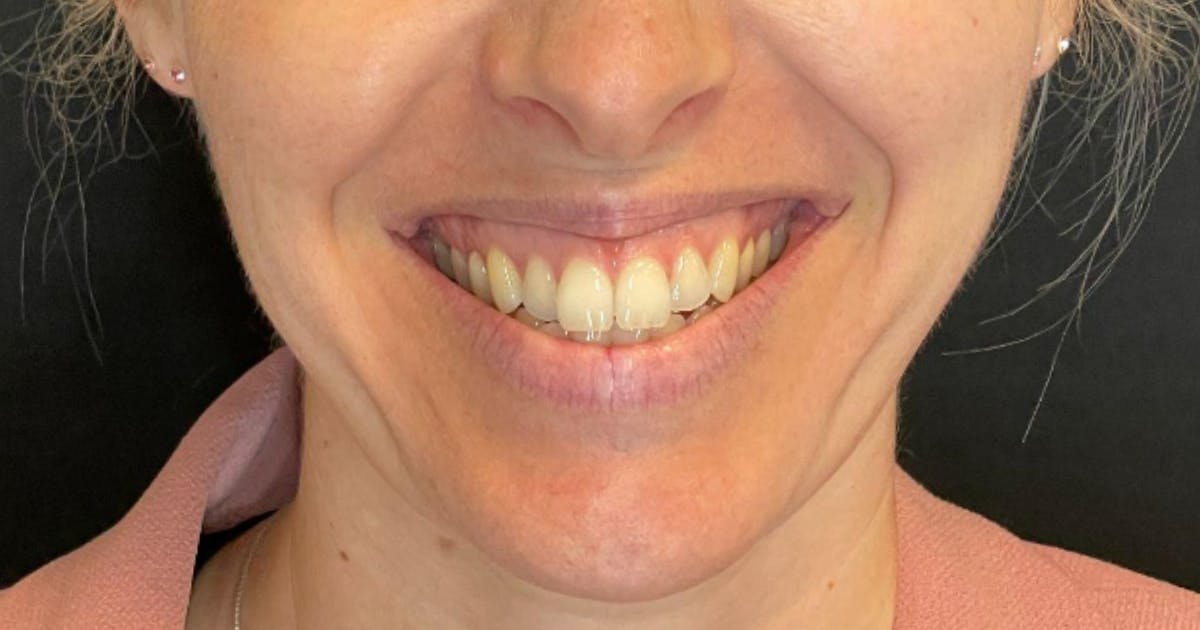 Gummy smile treatment for excessive gingival display