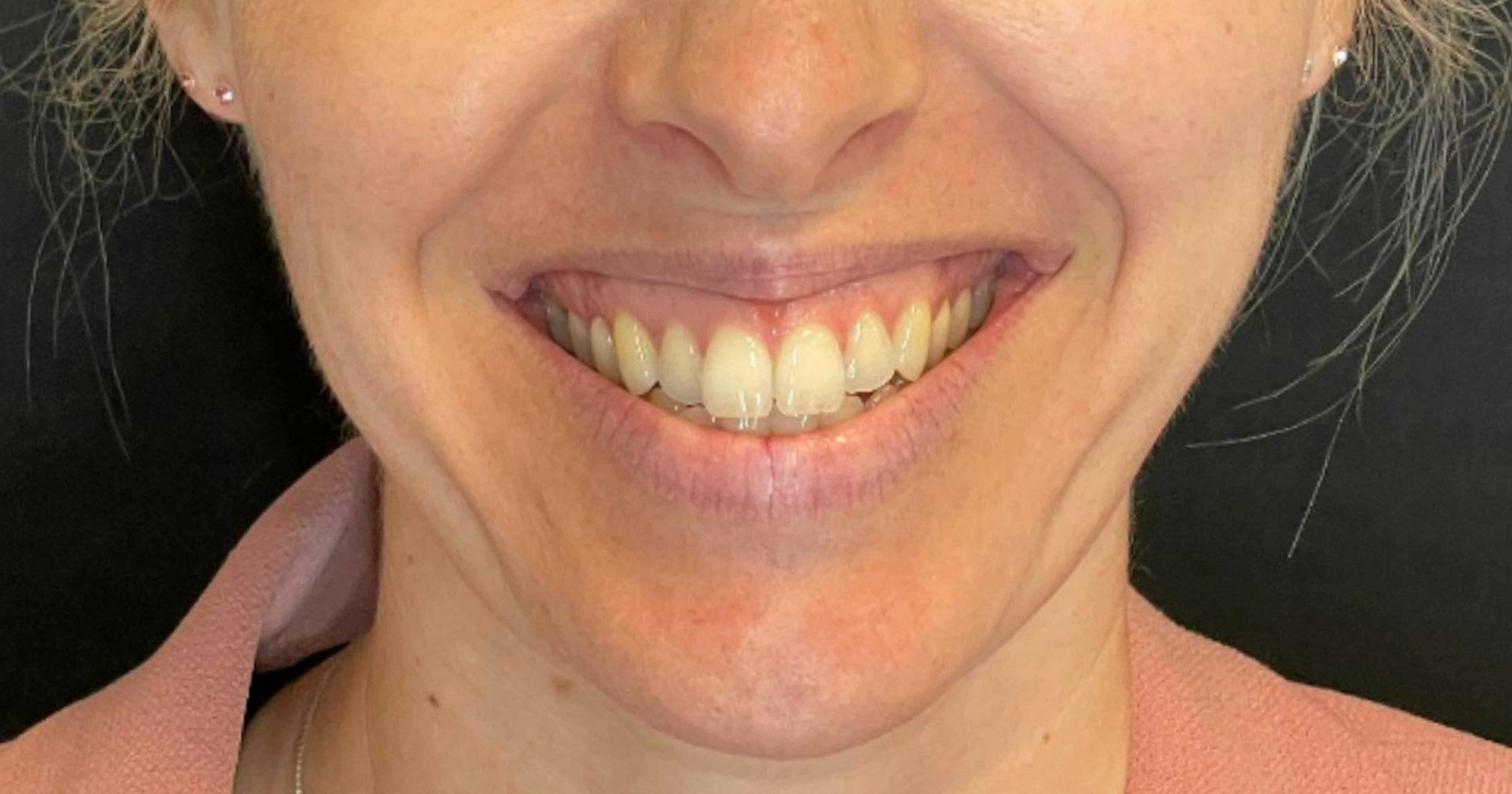 Gummy smile treatment for excessive gingival display