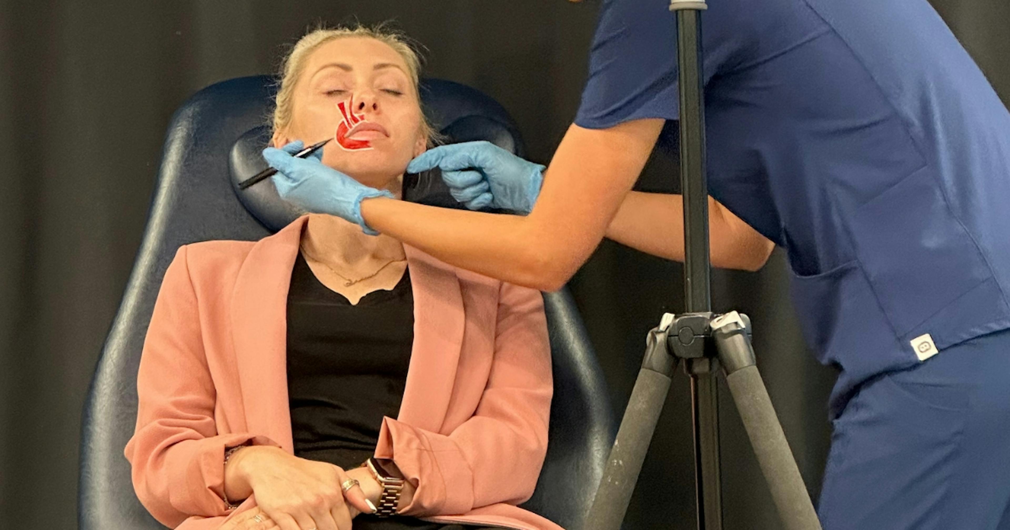 marking up the facial anatomy for aesthetics training in gummy smile treatment