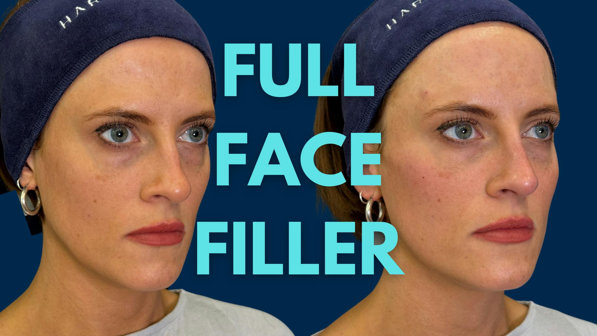 GEM by Harley Academy Live Full Face Filler Multi Area Treatment Demonstration
