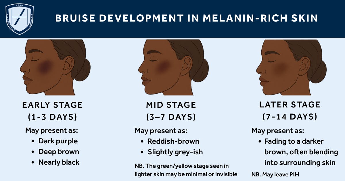 How bruises present and develop in Black skin - Harley Academy diagram for aesthetic practitioners