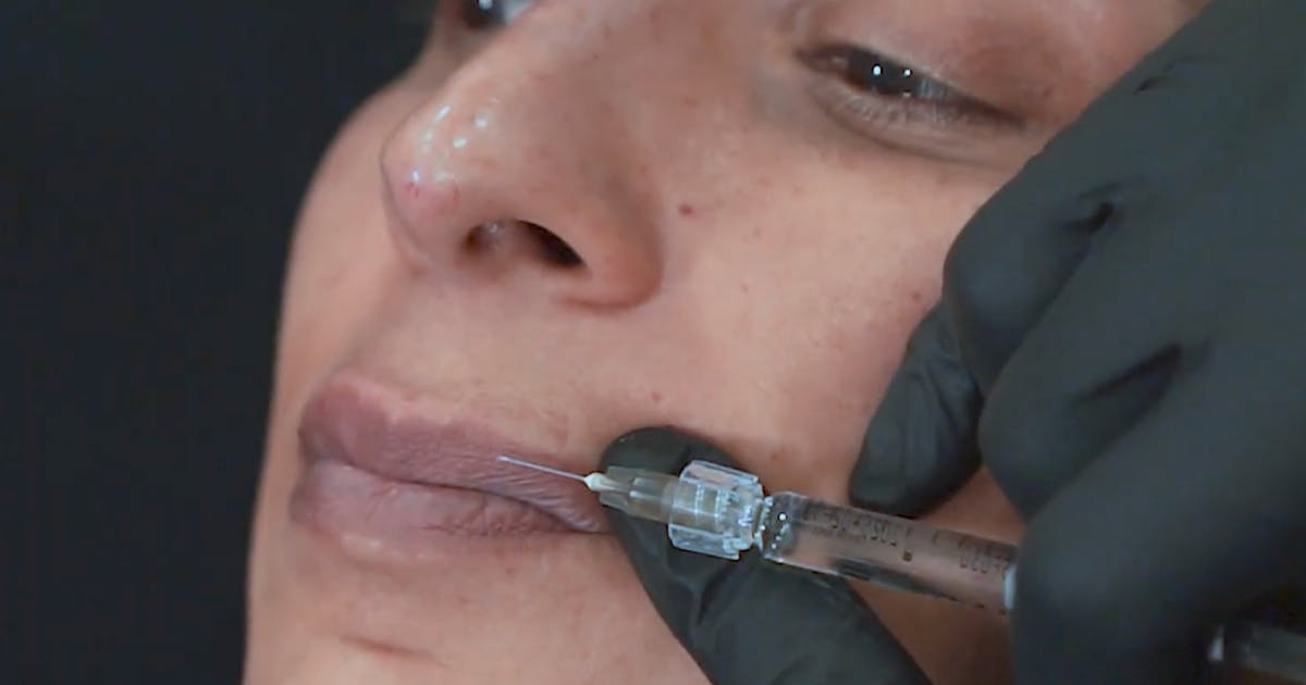 Evidence-Based Lip Filler Injection Technique - Harley Academy Accredited Medical Aesthetics Training Courses