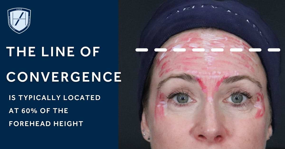 Locating the Line of Convergence - Diagram - Upper Face Anatomy