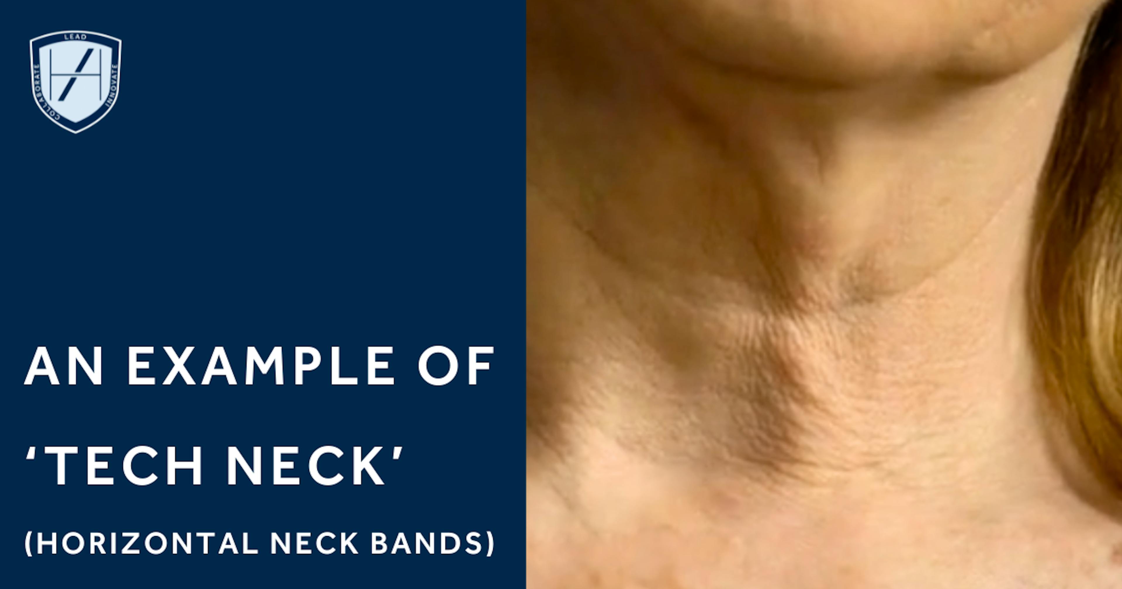 An example of what tech neck looks like - horizontal neck bands