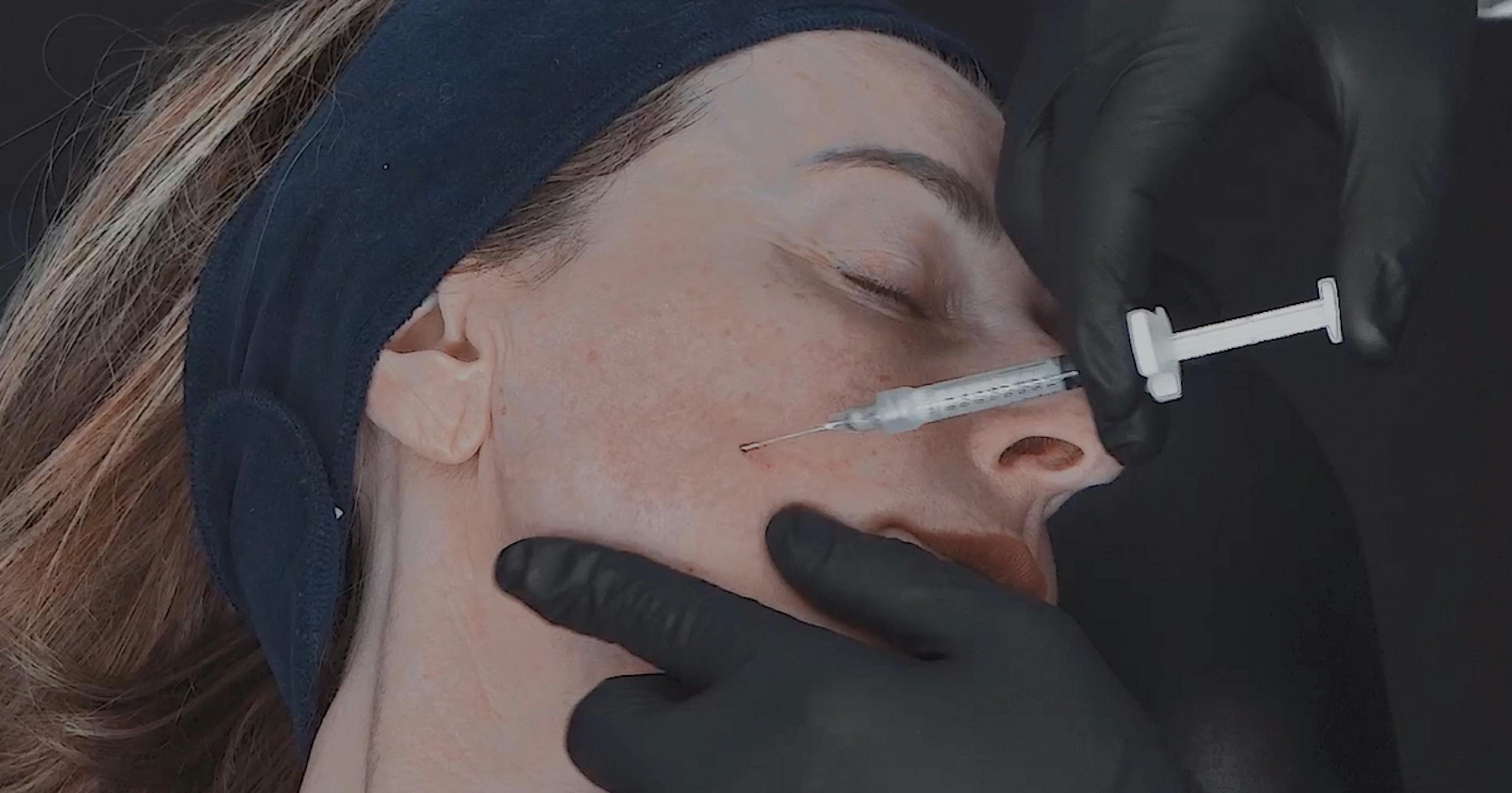 Biostimulator Skin Treatment with Ellansé in GEM Clinic case study
