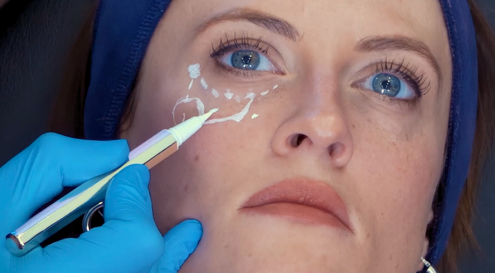 Tear trough filler marking up - under eye anatomy for aesthetic practitioners