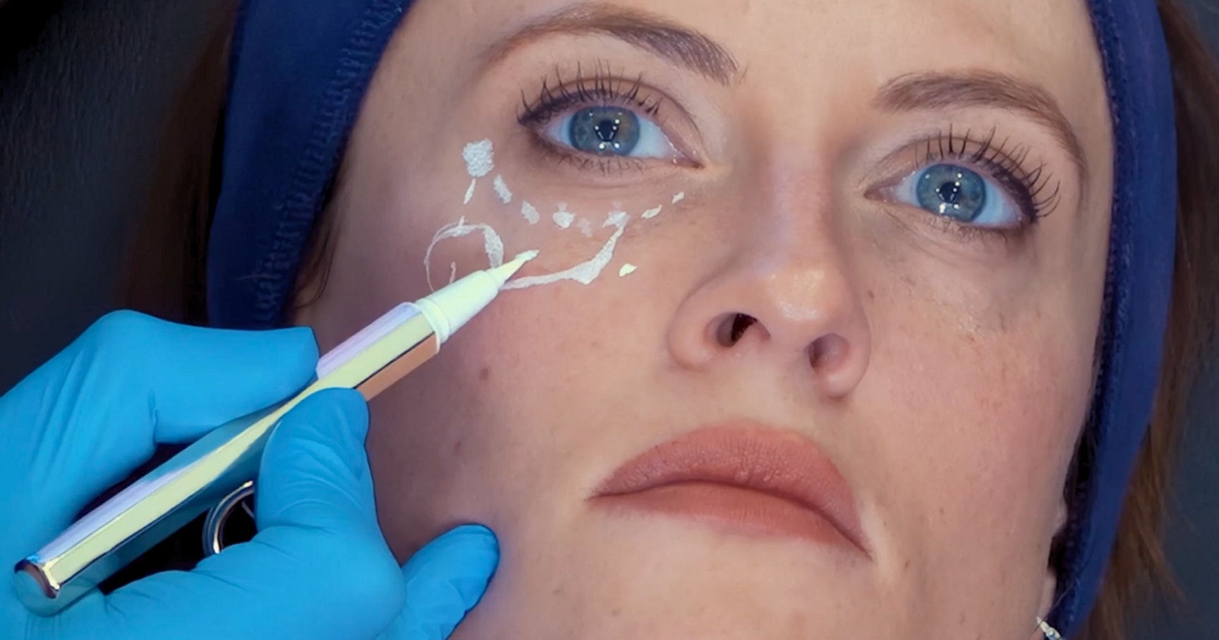 Tear trough filler marking up - under eye anatomy for aesthetic practitioners