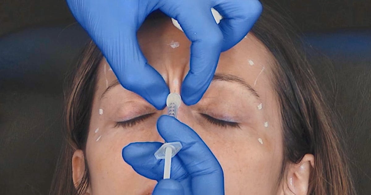 Upper Face Botox - Treating the Glabella with Botulinum Toxin at Harley Academy