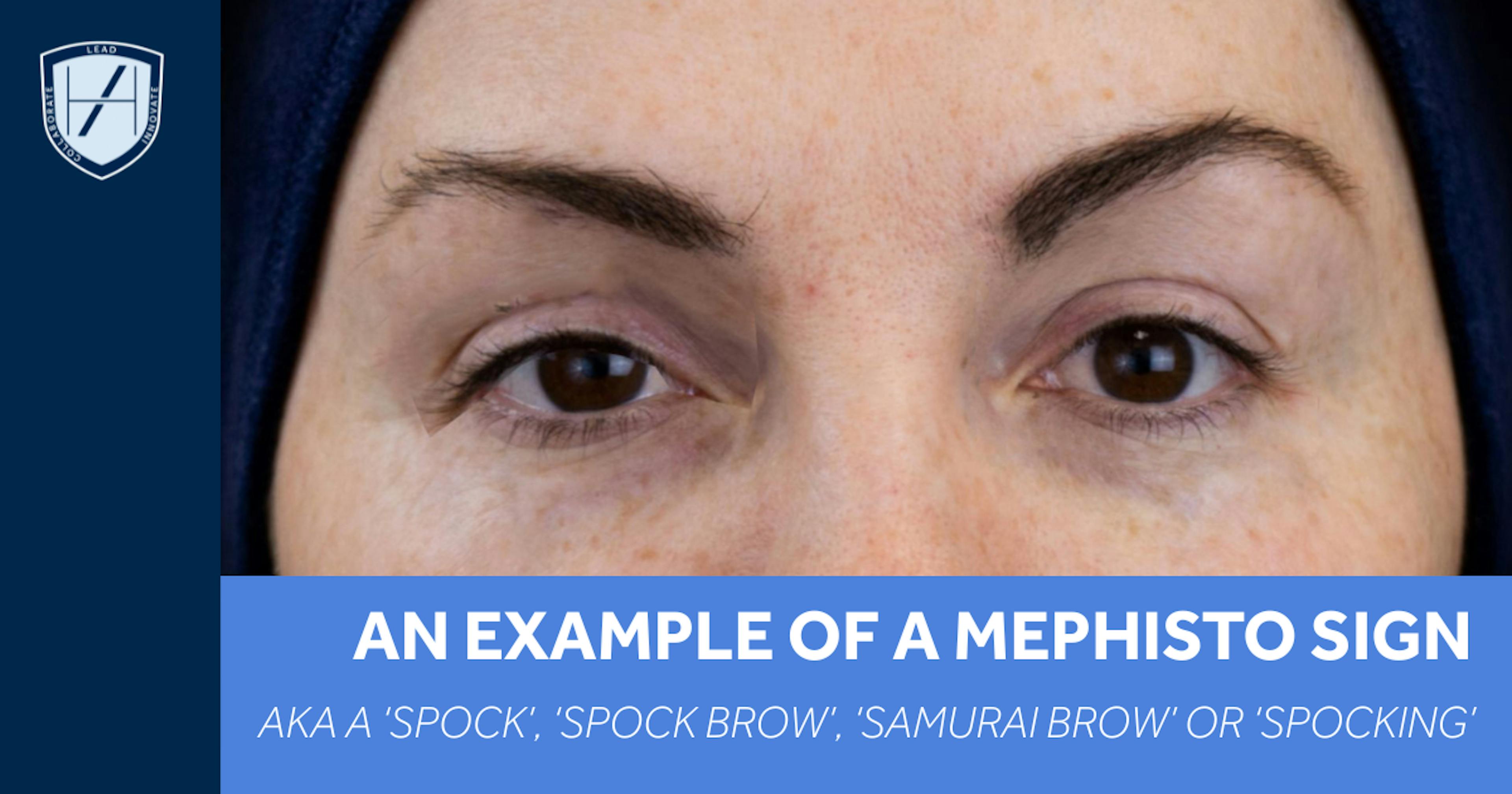 What a mephisto sign looks like - spock brow after botulinum toxin 