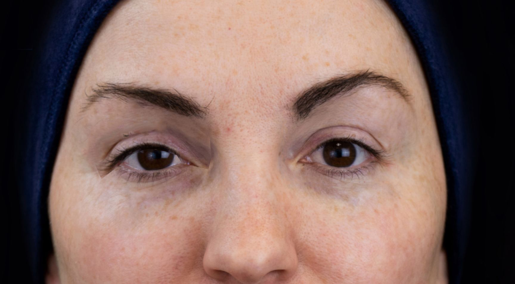 Example of a mephisto sign aka a spock brow