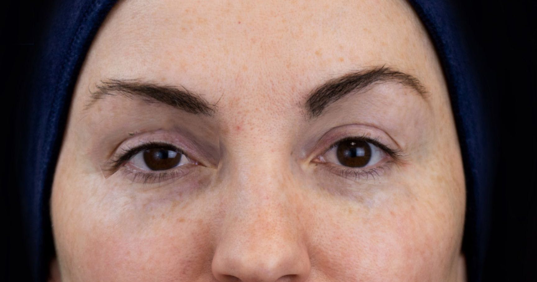 Example of a mephisto sign aka a spock brow