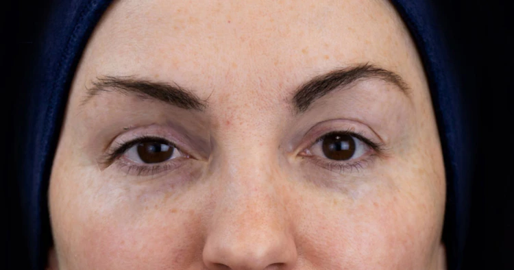 Understanding Botox Complications: Spocking and Brow Ptosis