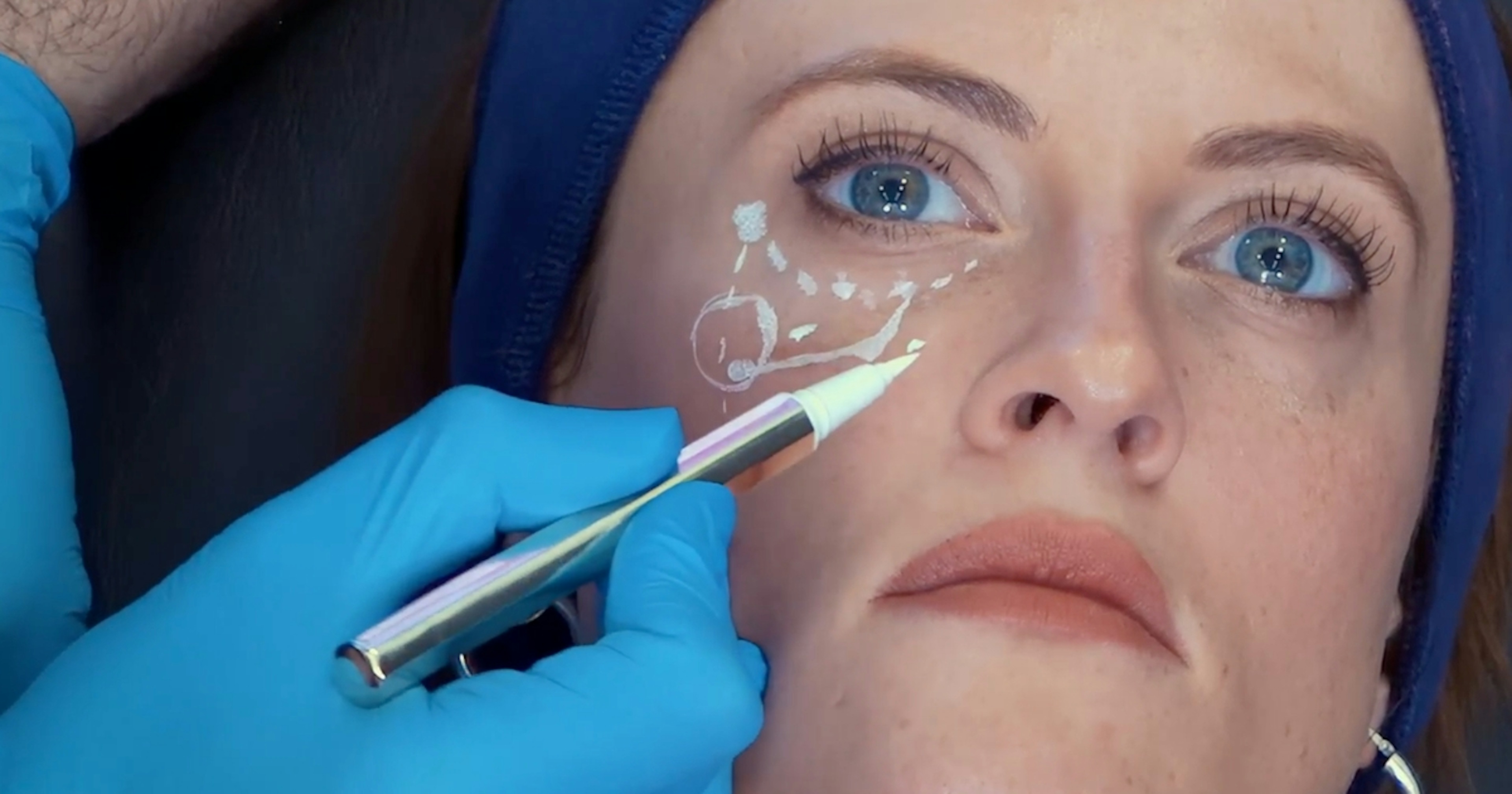 Marking up filler treatment courses Harley Academy medical aesthetics courses for healthcare professionals