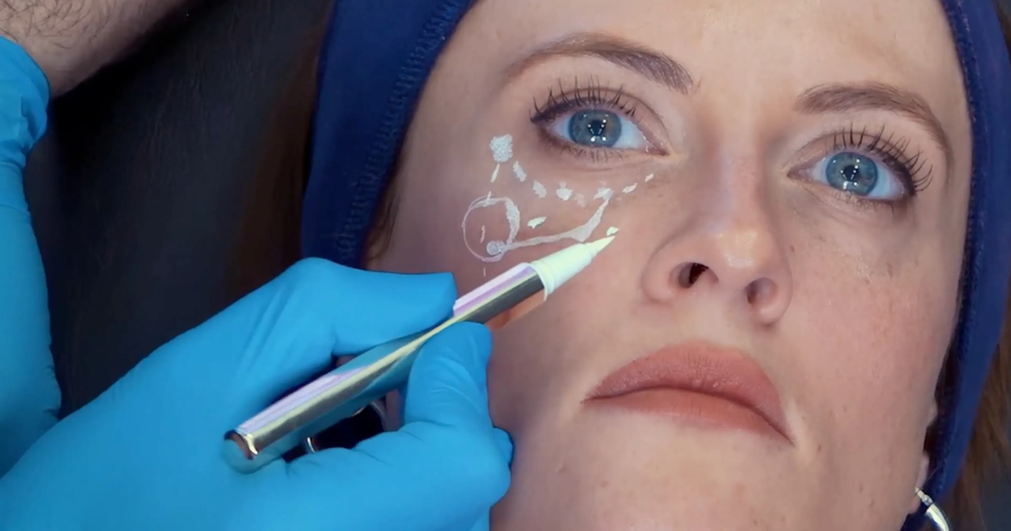 Marking up filler treatment courses Harley Academy medical aesthetics courses for healthcare professionals