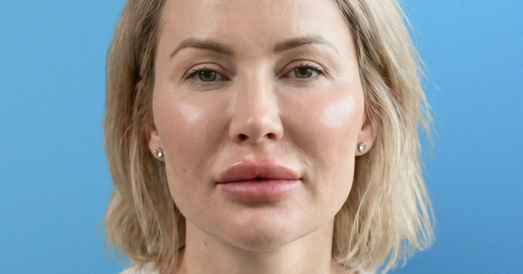 Example of Facial Overfilled Syndrome