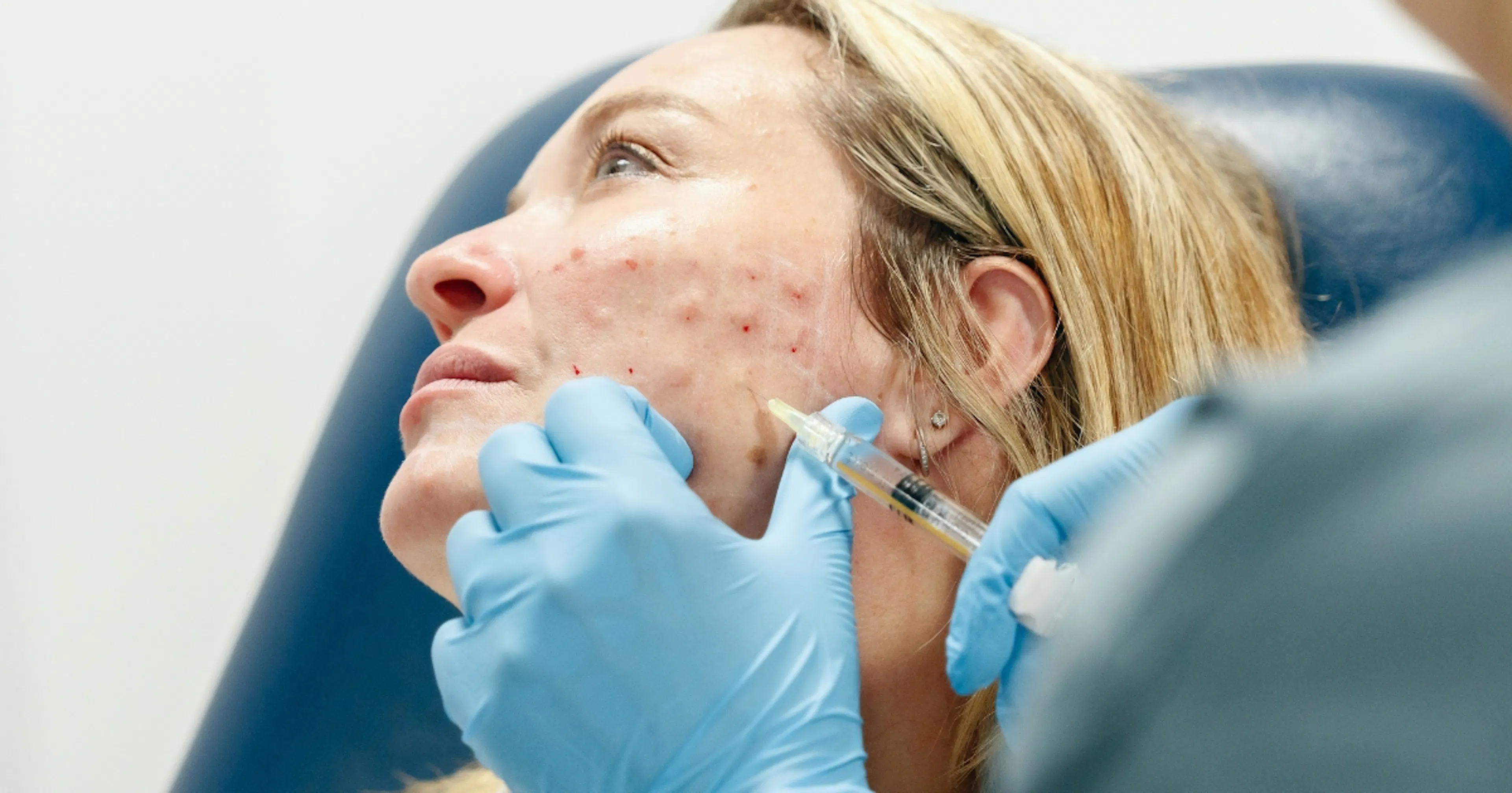 Polynucleotide injections for full face treatment during Harley Academy Polynucleotides Training Course