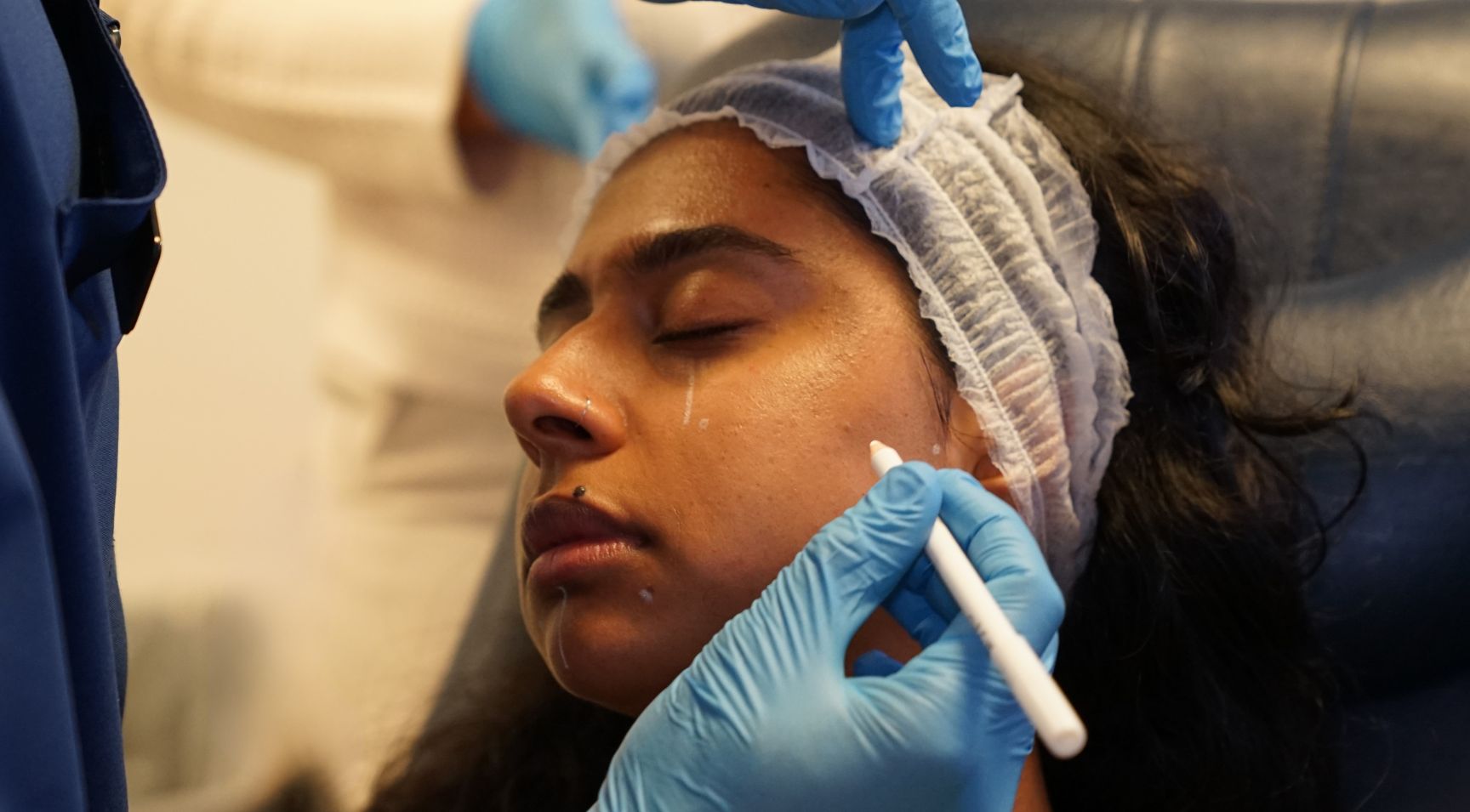 Marking up a patient for Profhilo during a Harley Academy Profhilo Training Course