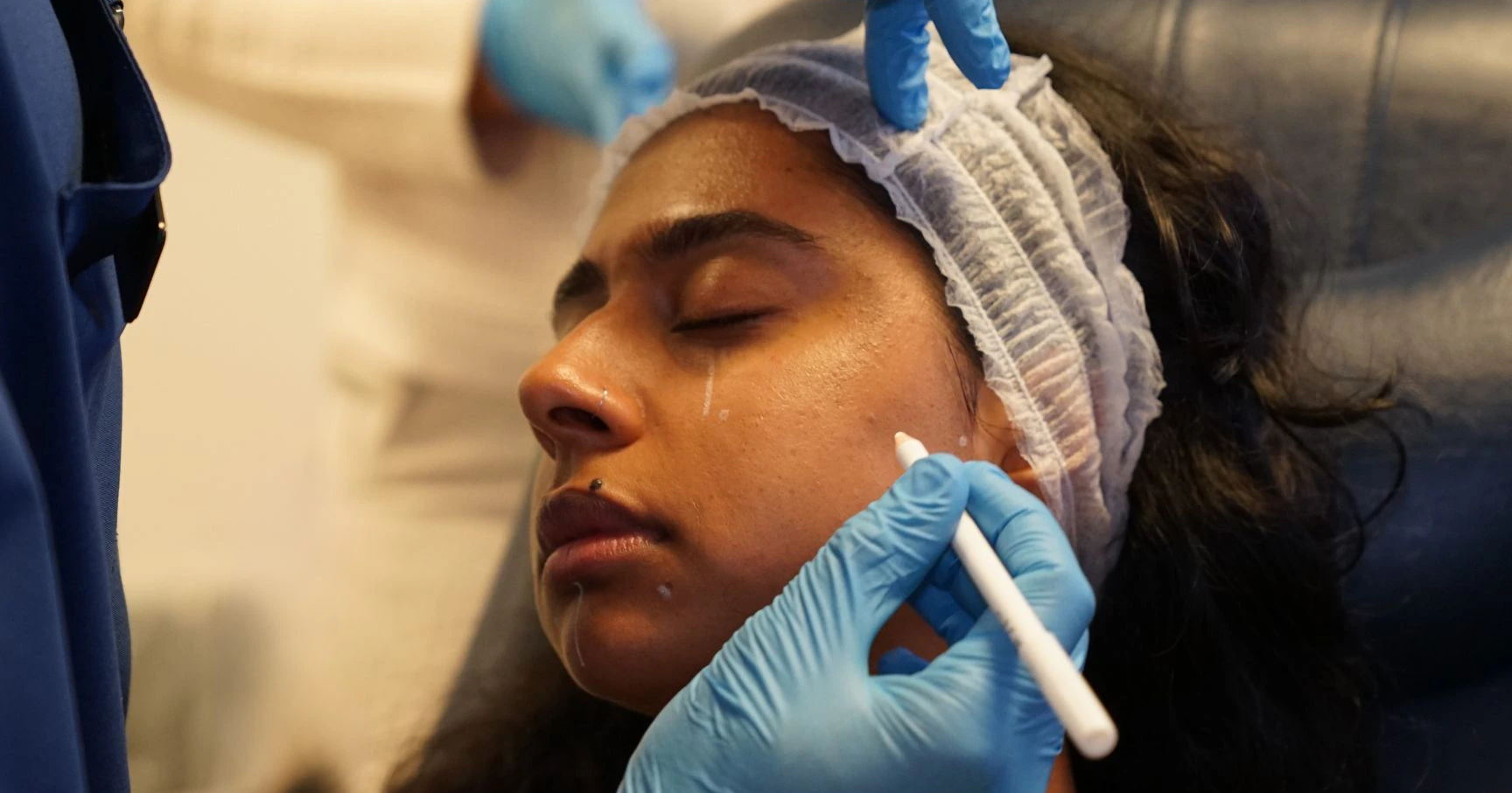 Marking up a patient for Profhilo during a Harley Academy Profhilo Training Course