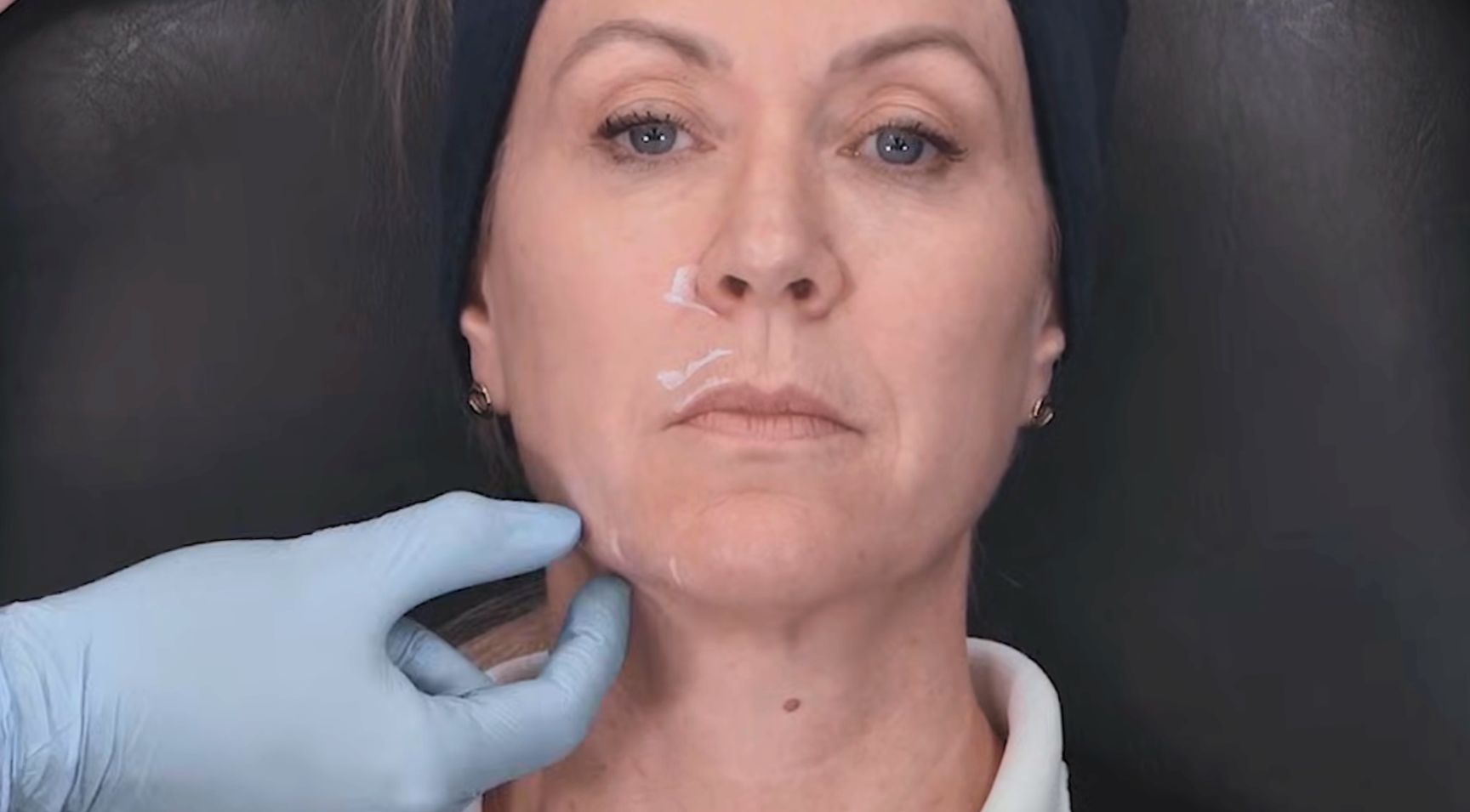 Locating the jowls - preparing patient for jowl filler at Harley Academy