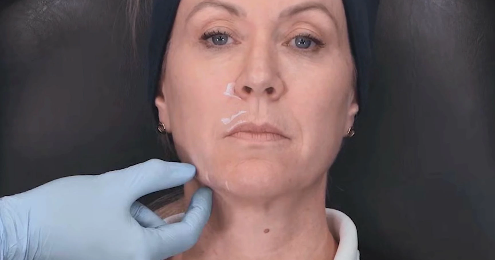 Locating the jowls - preparing patient for jowl filler at Harley Academy