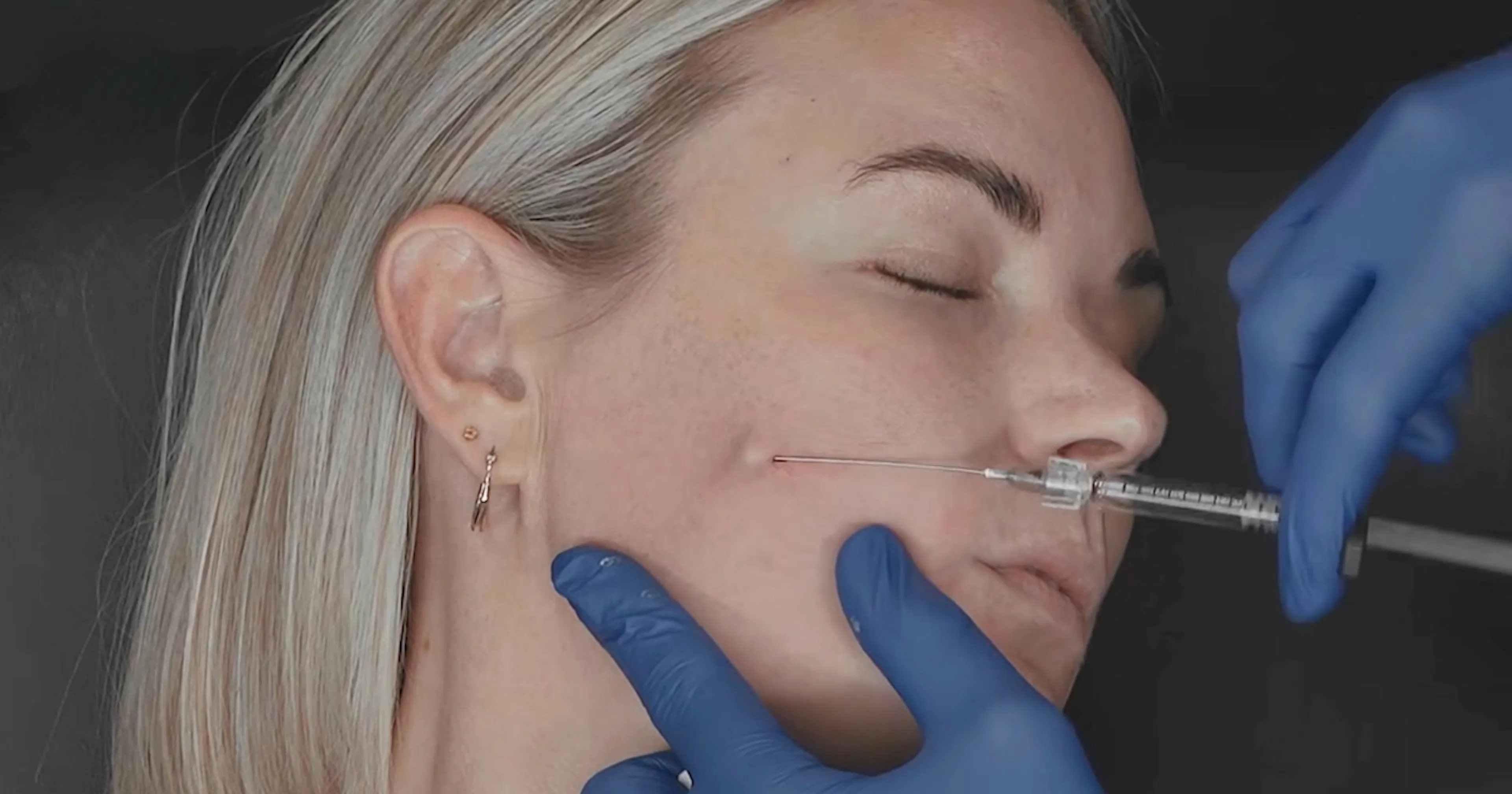 Dr Tristan Mehta demonstrates Subcision before dermal fillers for aesthetic practitioners