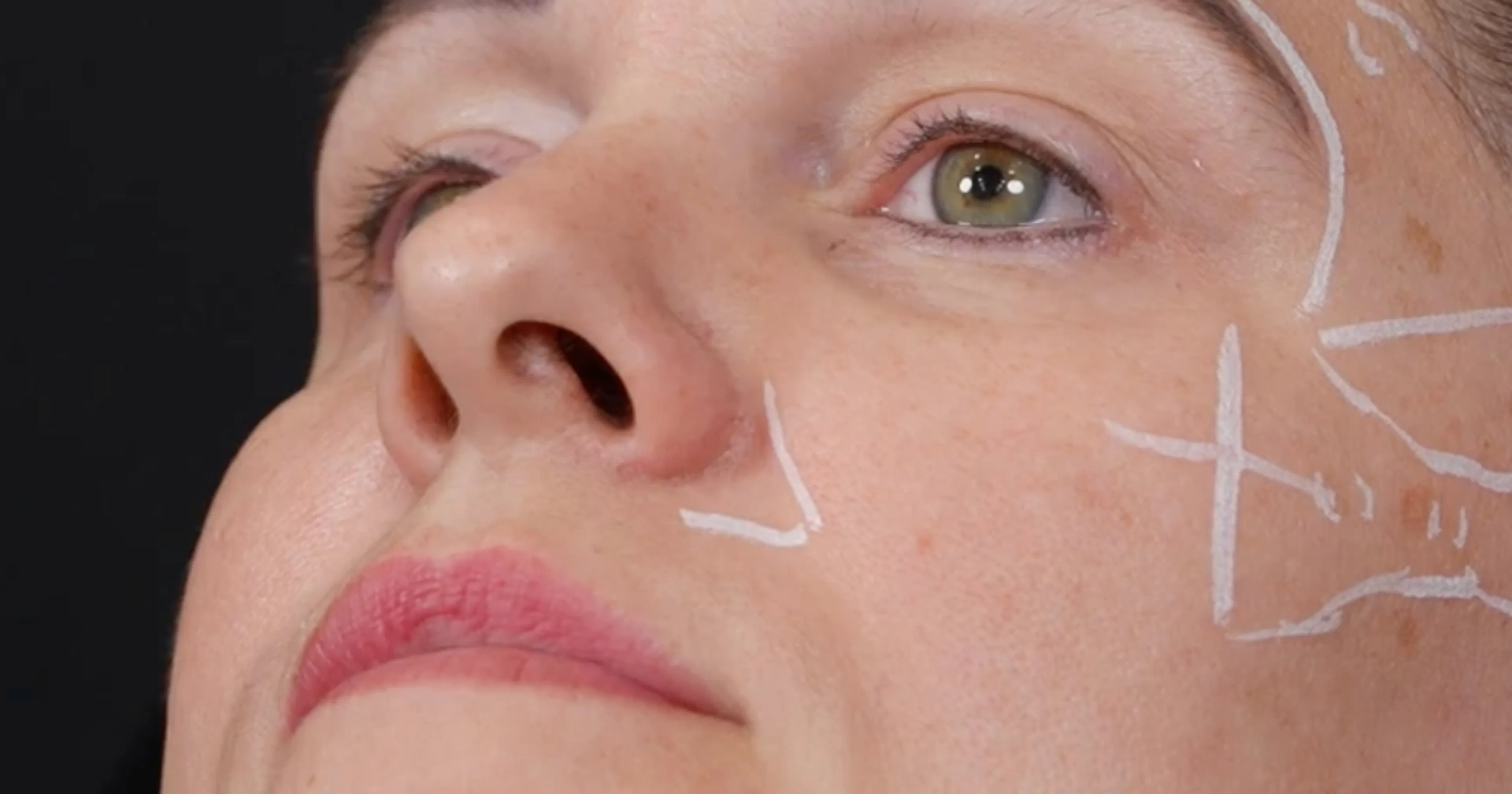 Filler patient with lip blush tattoo - advice on how to treat this cohort for aesthetic practitioners