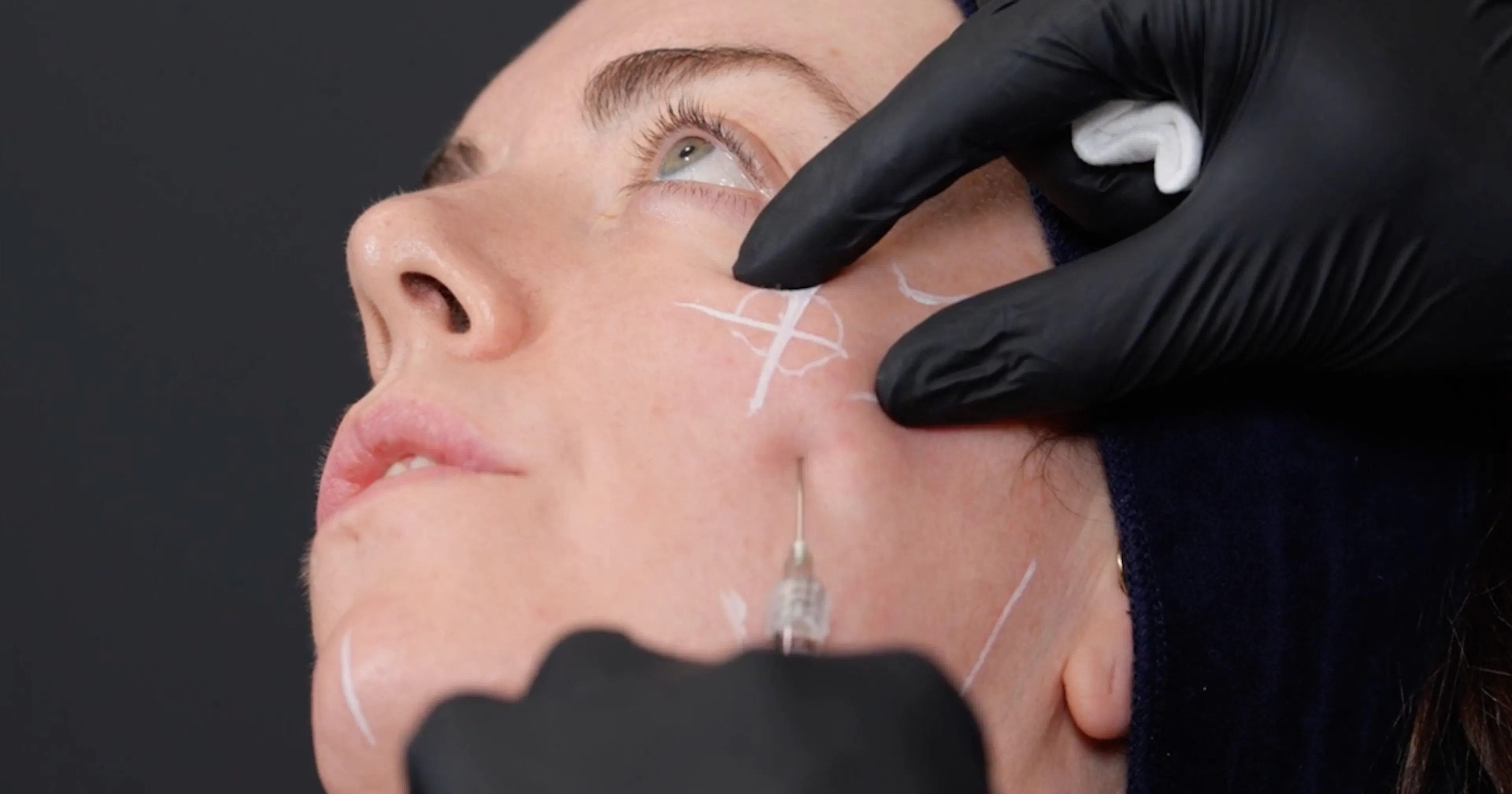 Injecting the cheek apex demonstrating evidence-based cheek filler techniques from GEM by Harley Academy