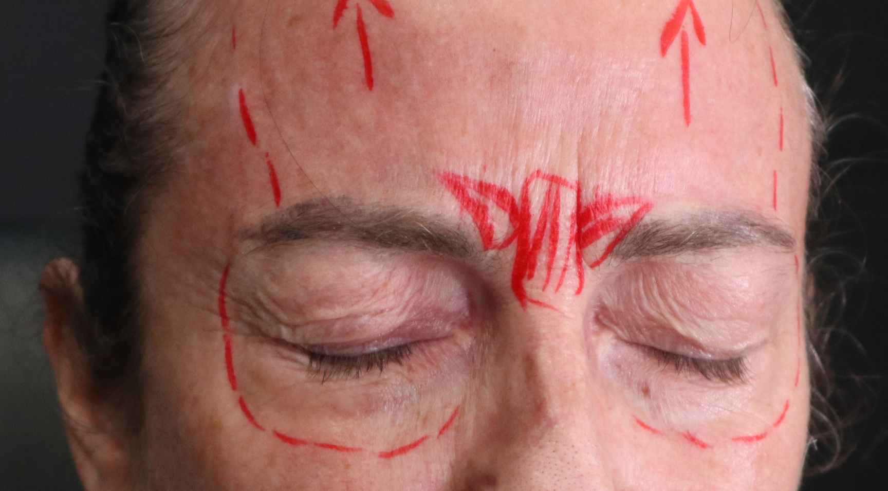 Marking up muscle activity relating to botulinum toxin treatments - upper face botox