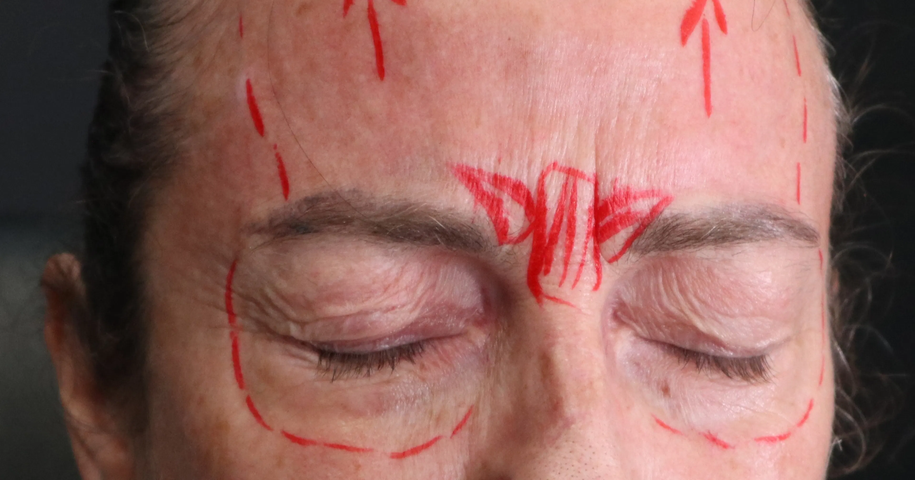 Marking up muscle activity relating to botulinum toxin treatments - upper face botox