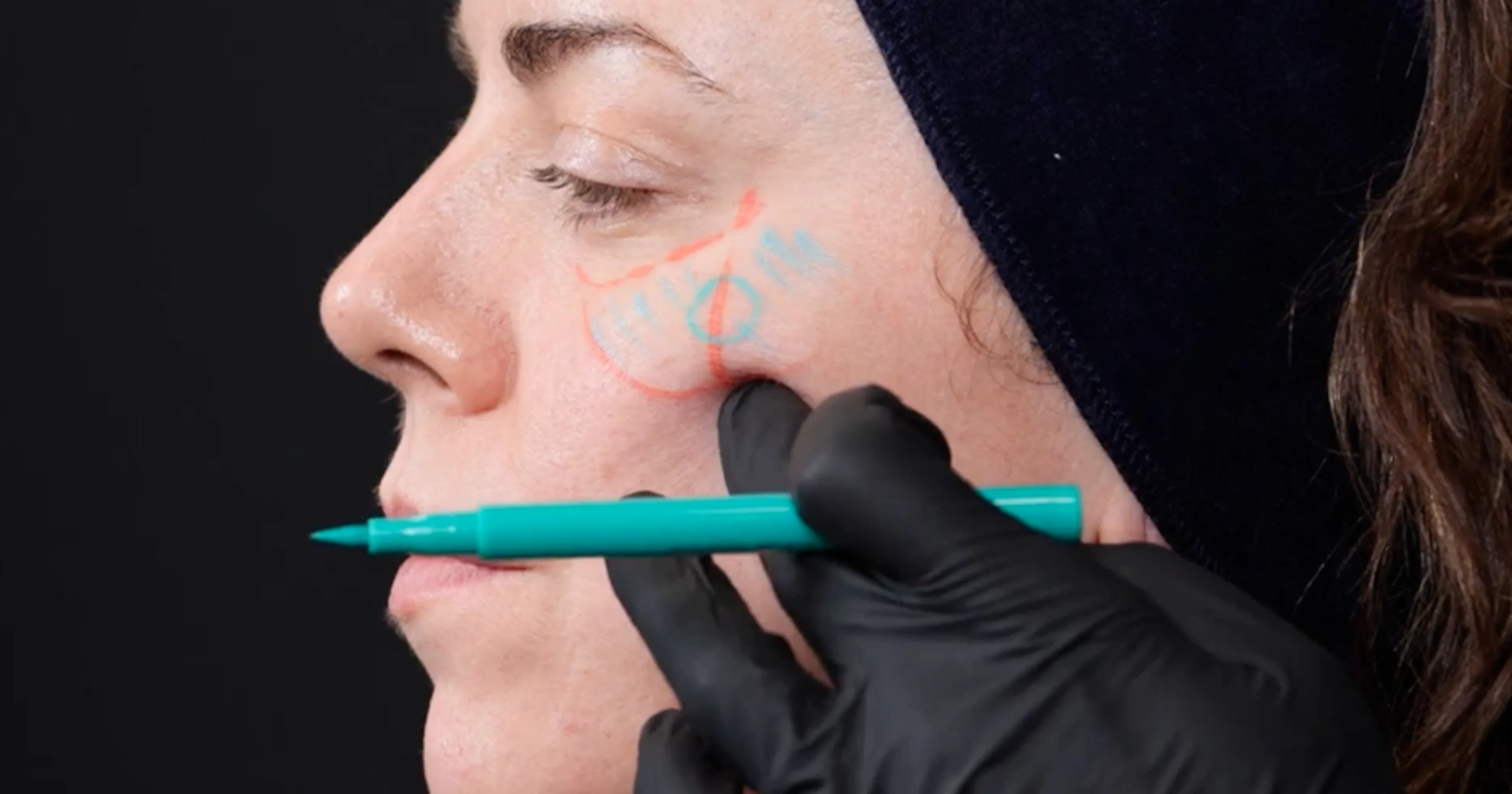How to locate the cheek apex for dermal filler treatments using GEM by Harley Academy evidence-based information for aesthetic practitioners