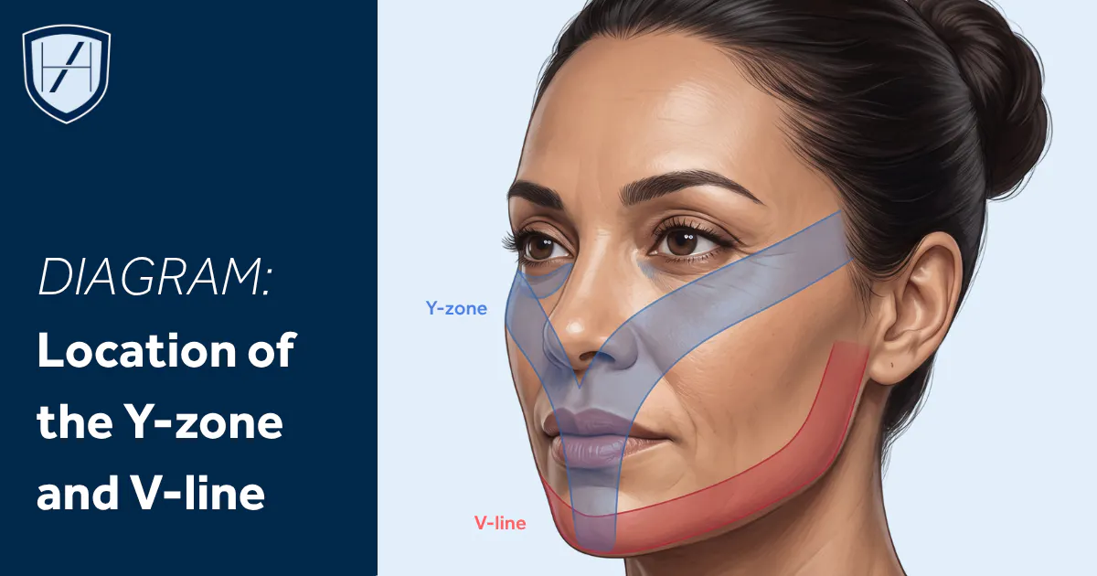 Facial Anatomy Diagram where to find the Y-zone and V-line