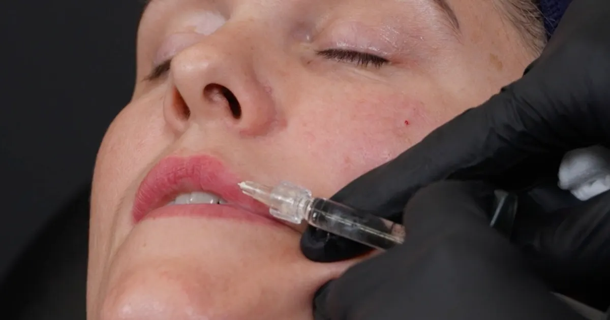 How to treat lip filler patients with lip blush tattoos (semi permanent lip makeup)