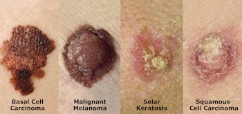 ¿Cómo luce el cáncer de piel?