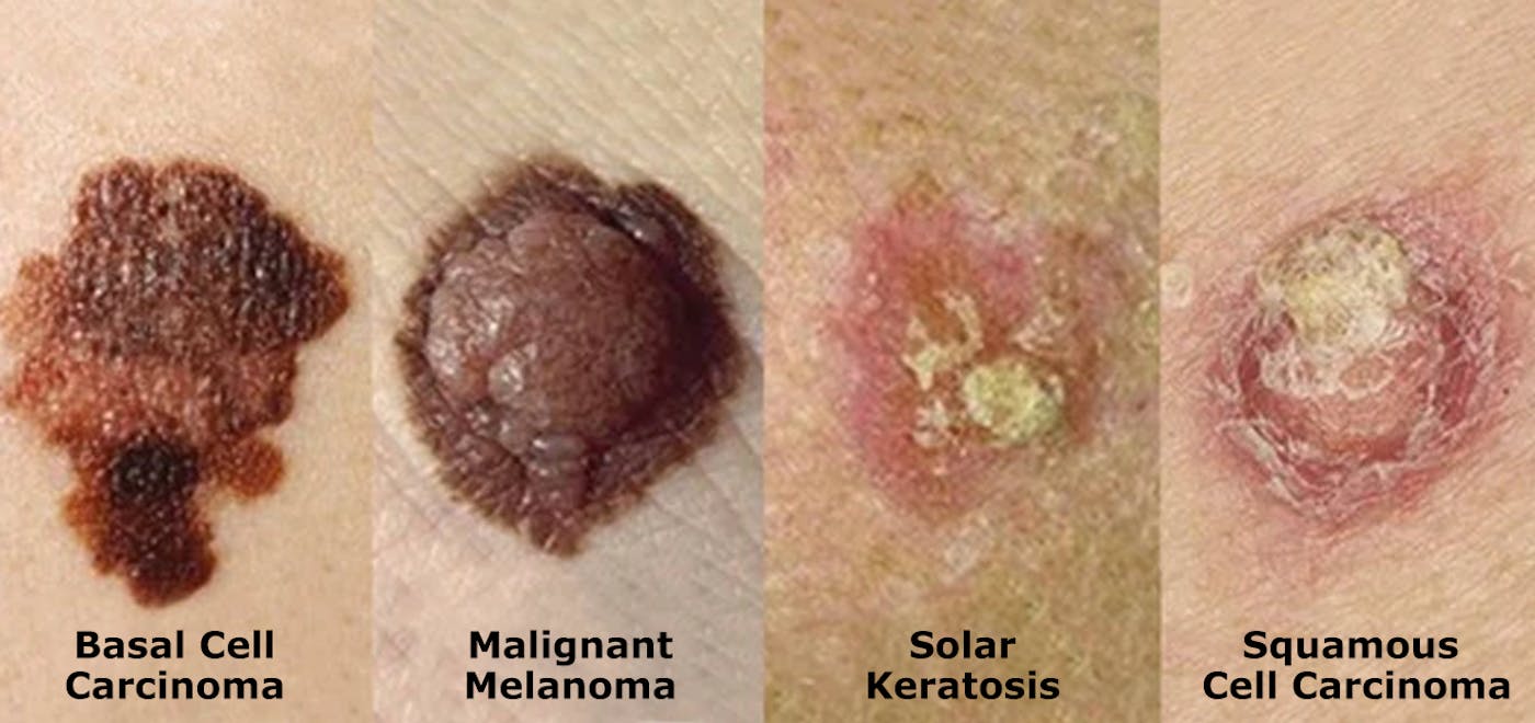 Does look what like melanoma a Melanoma Pictures