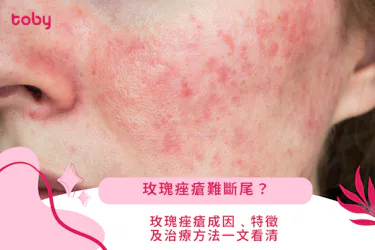 玫瑰痤瘡難斷尾?玫瑰痤瘡成因﹑特徵及治療方法一文看清