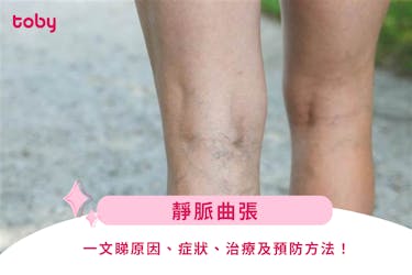 【靜脈曲張】靜脈曲張分7期?一文睇原因、症狀、治療及預防方法!