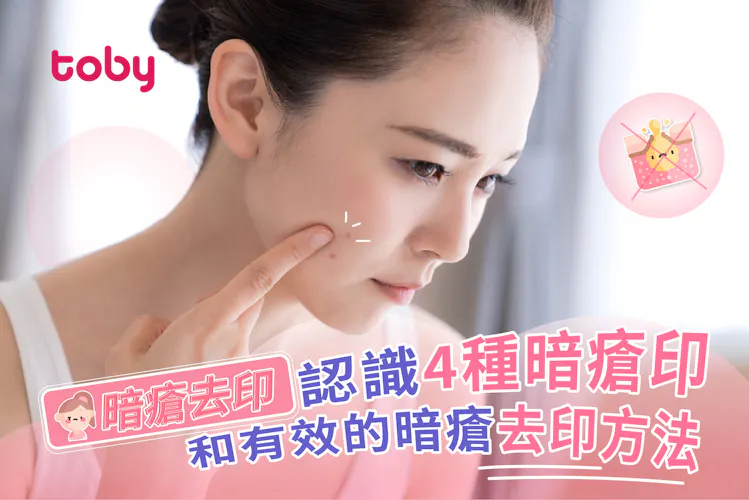 【去暗瘡印】4個速效去印方法 你屬於哪種暗瘡印?-banner