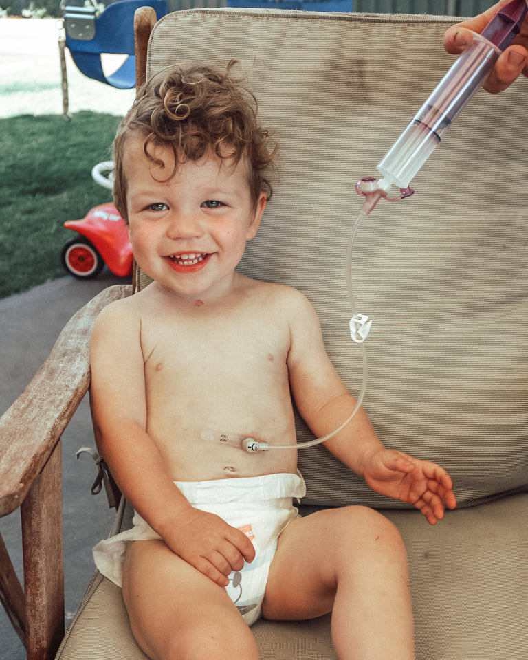 A toddler is sitting on an outdoors chair. He has messy, curly hair and is smiling. He is being tube-fed. 