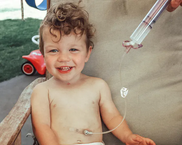 A toddler is sitting on an outdoors chair. He has messy, curly hair and is smiling. He is being tube-fed.