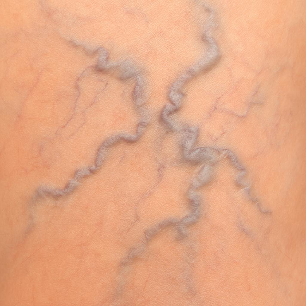 Variz gruesa