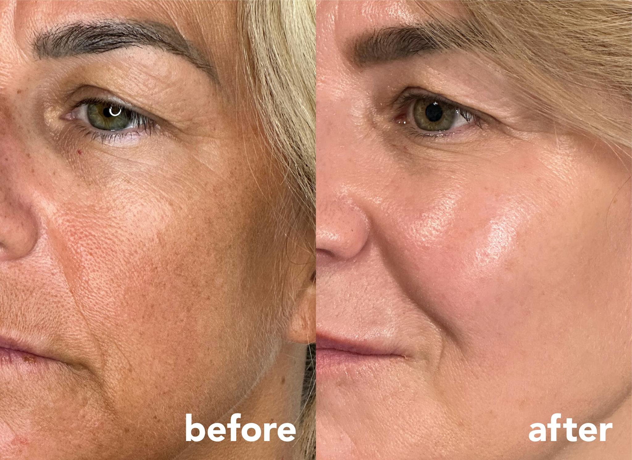 Before and after results following full face rejuvination treatment