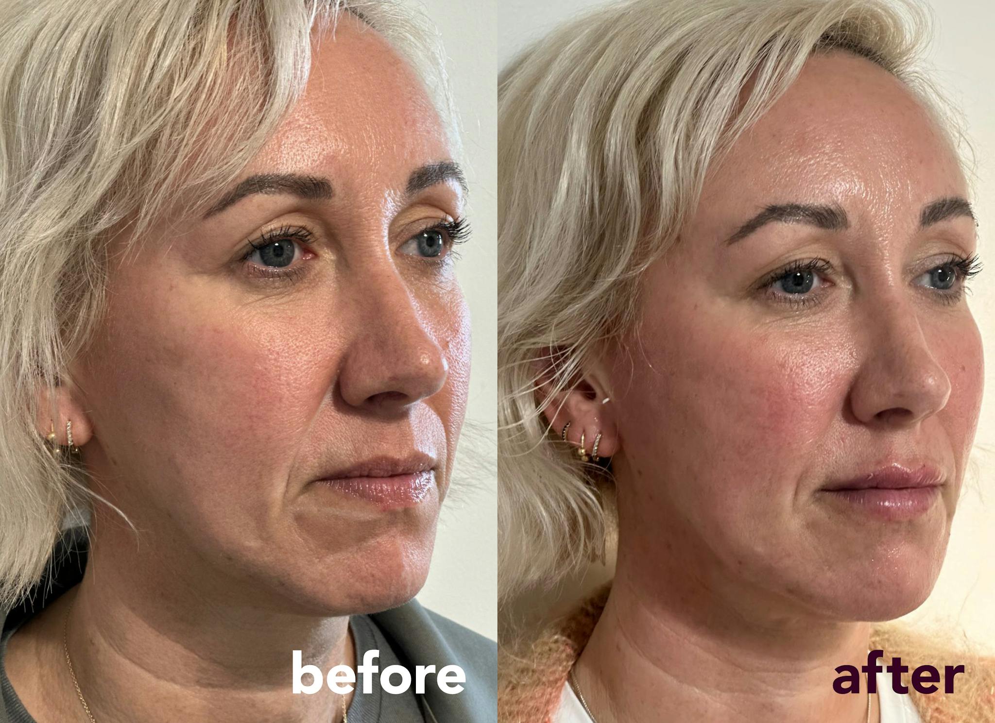 Before and after results following full face rejuvenation treatment