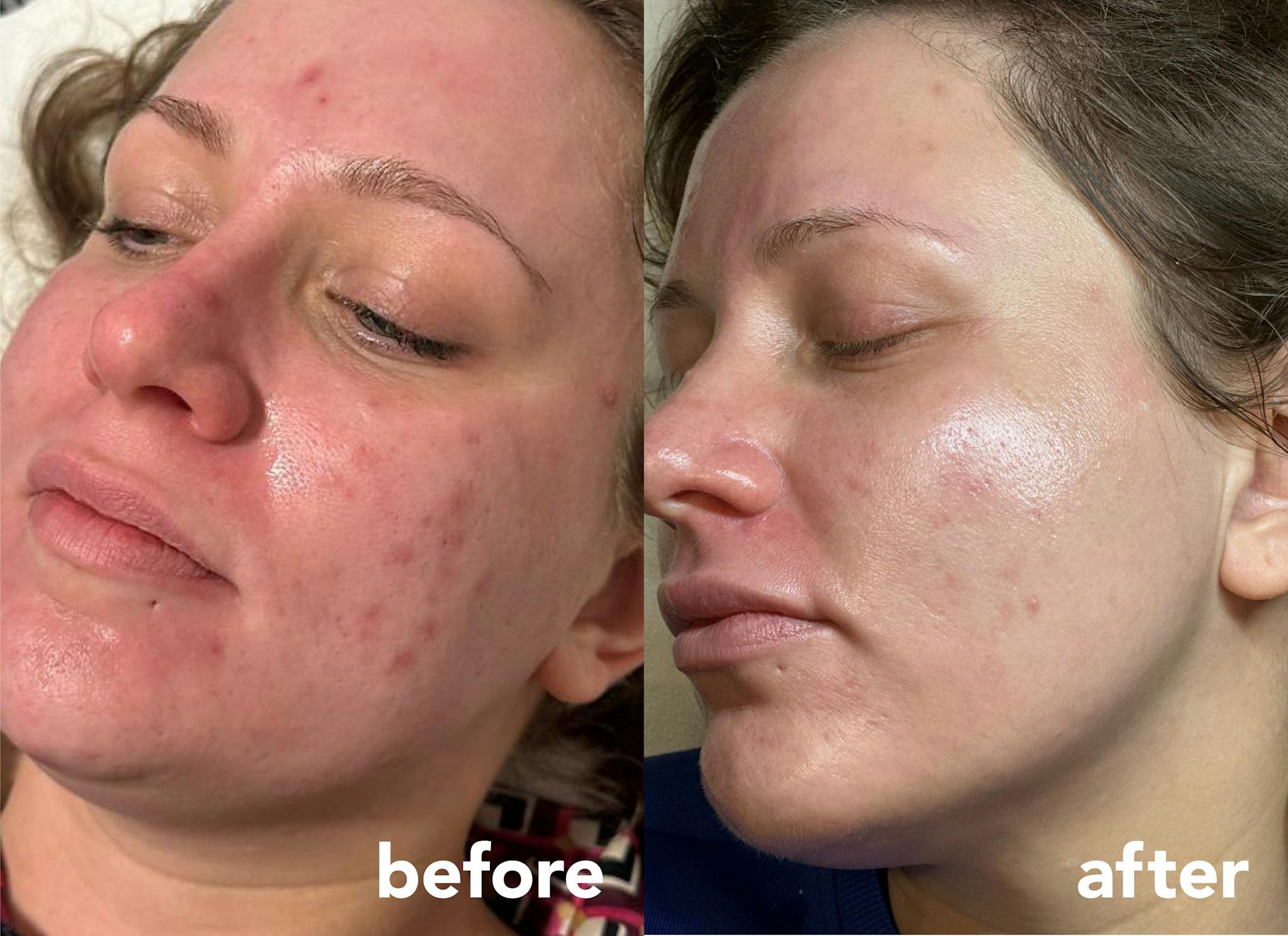 Before and after results following a course of 3 ID Clinica BioSpicules treatments combined with plant-based exosomes