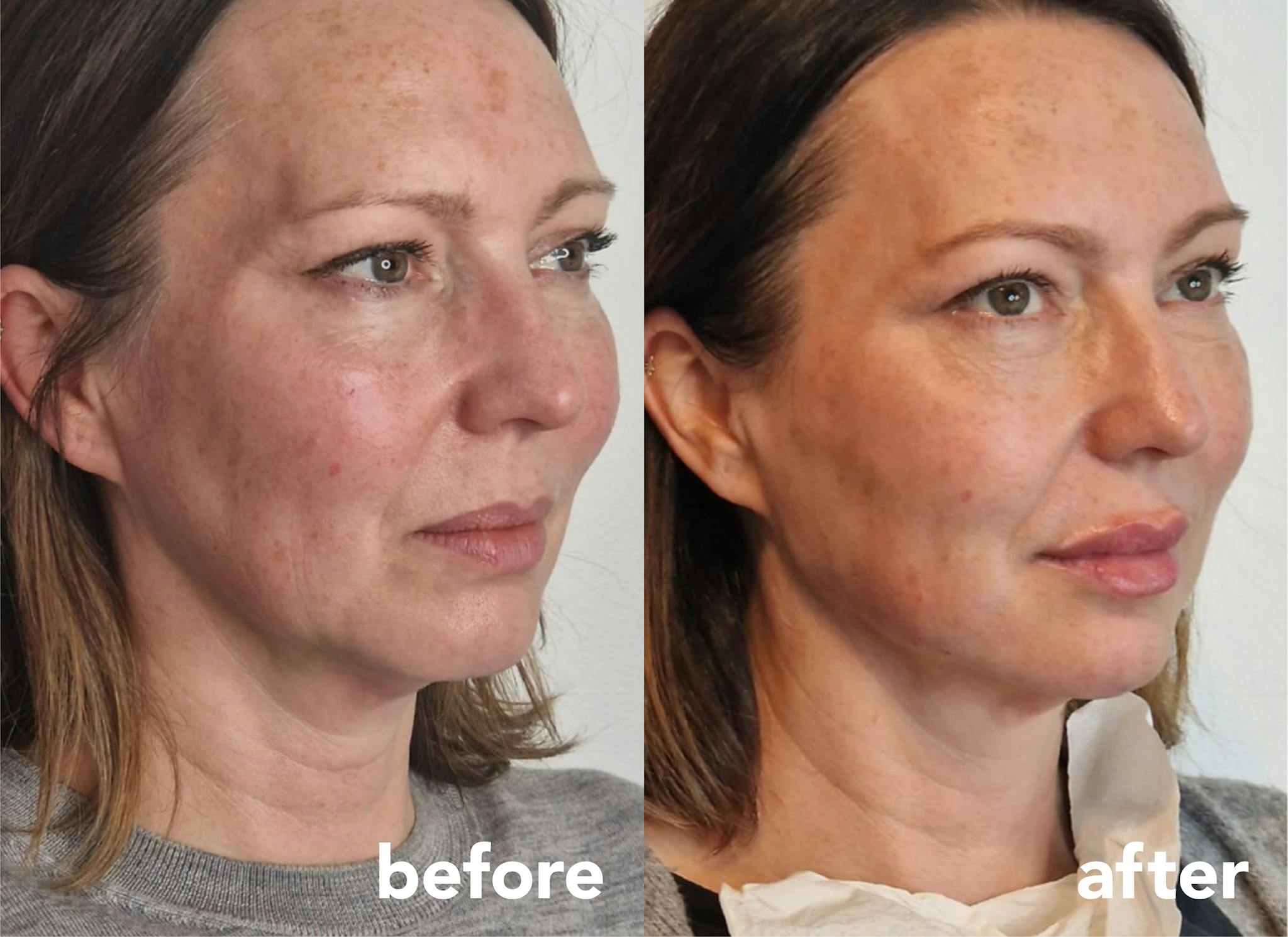 Before and after results following Full Face Rejuvenation treatment