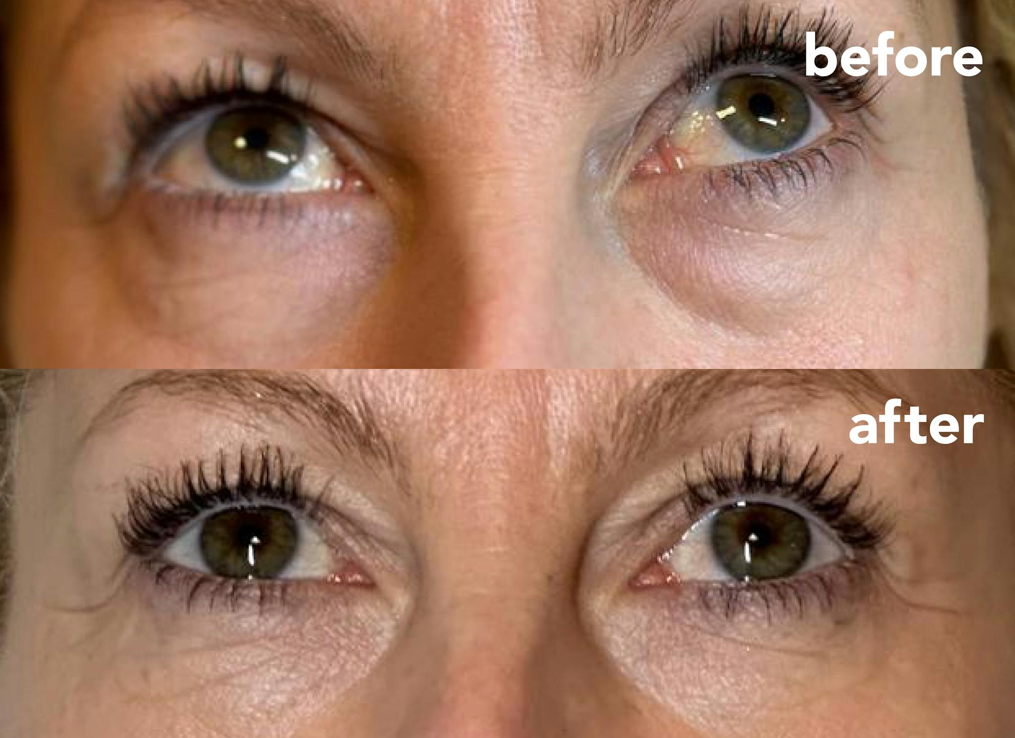 Before and after results following Under-Eye Rejuvenation treatment
