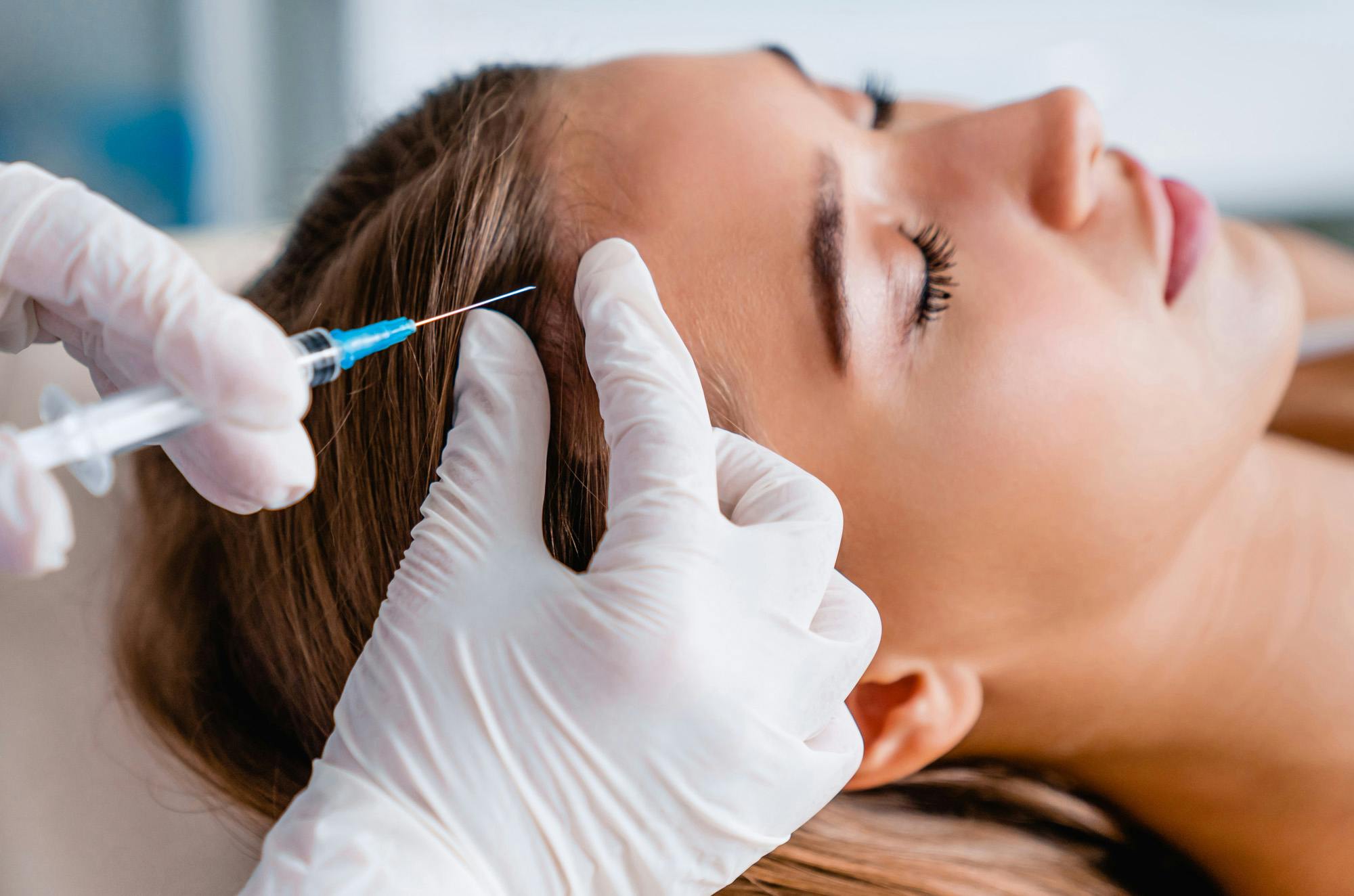 A woman receiving injections to her scalp area as part of her hair regrowth treatment