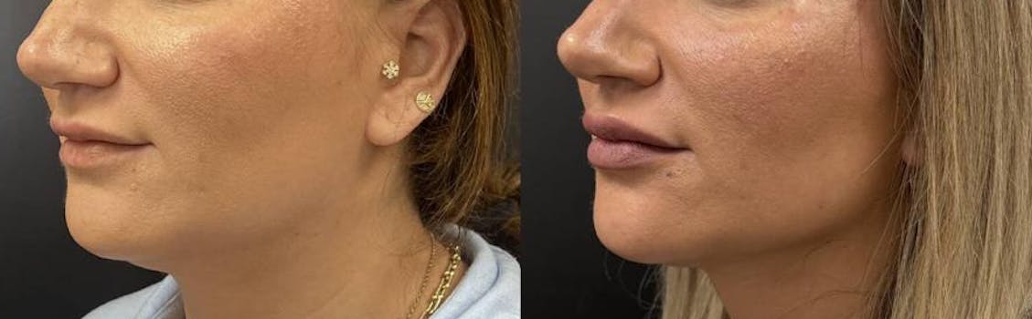 A Lipolas patient with their before and after results