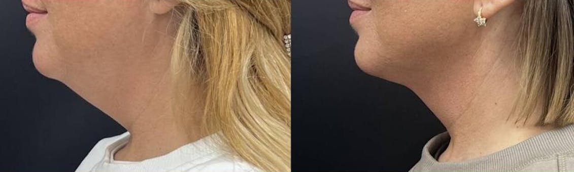 patient Lipolas® before and after skin tightening non surgical face lift