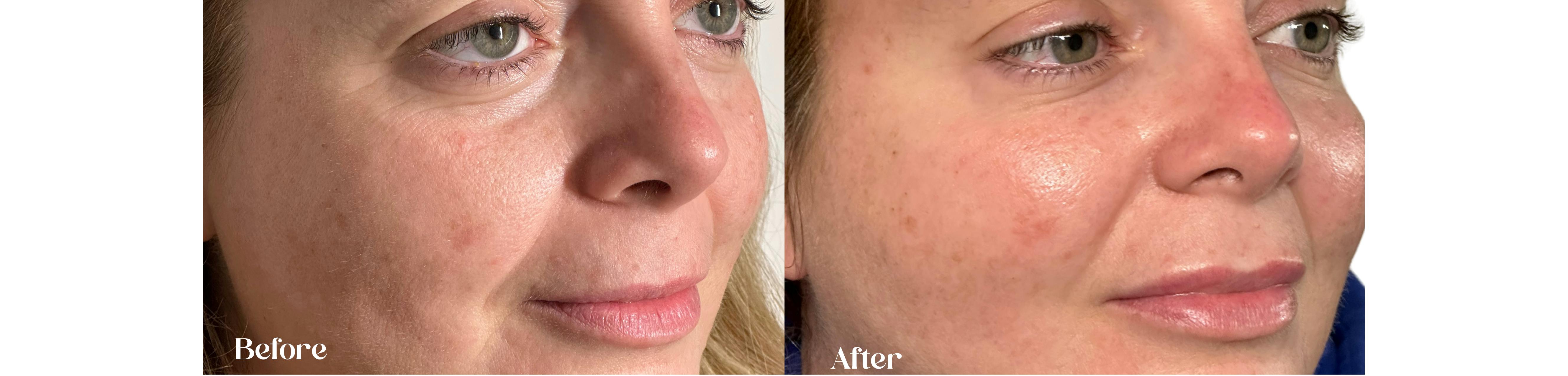 House of Glo before and after results botox